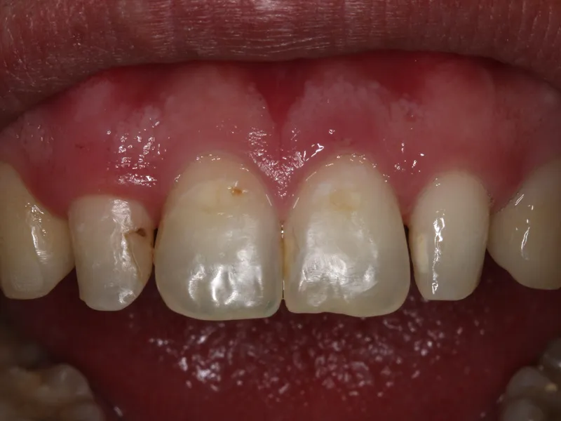 Before: close-up of upper front teeth with chipped, worn edges